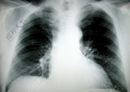 X射线肋骨扫描图片